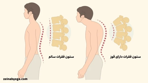 قوز پشت چیست؟